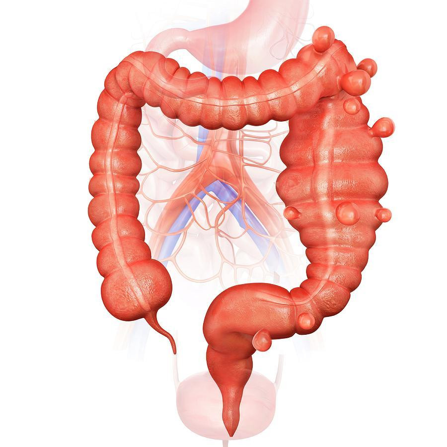 Diverticulitis